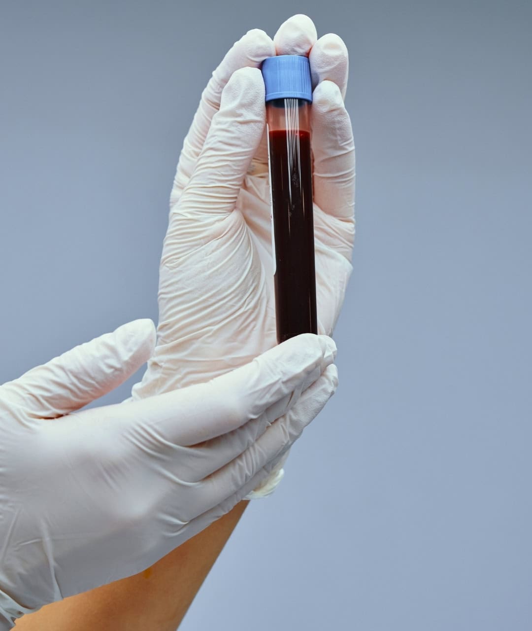 Hand holding a blood sample in a test tube for Lyme disease testing.